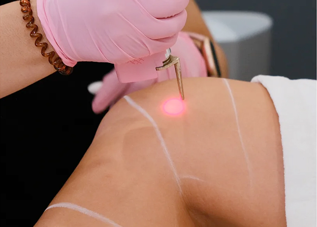 LaserAway